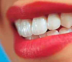 closeup image of woman's teeth as she's smiling
