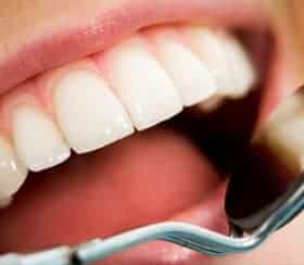 Dental Implants Image