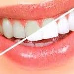 teeth whitening dentist ny