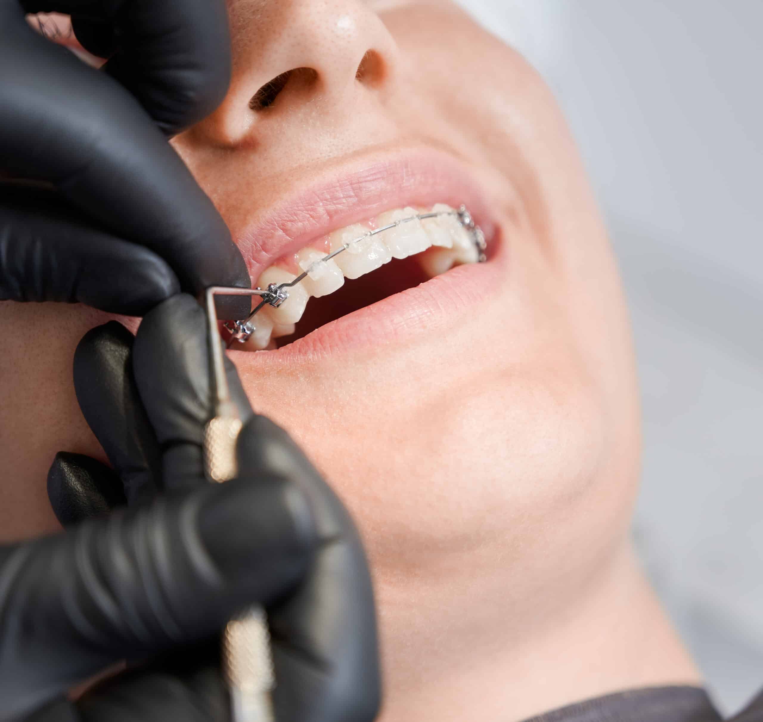 The Benefits of Invisalign over Traditional Braces - Dr. Scott