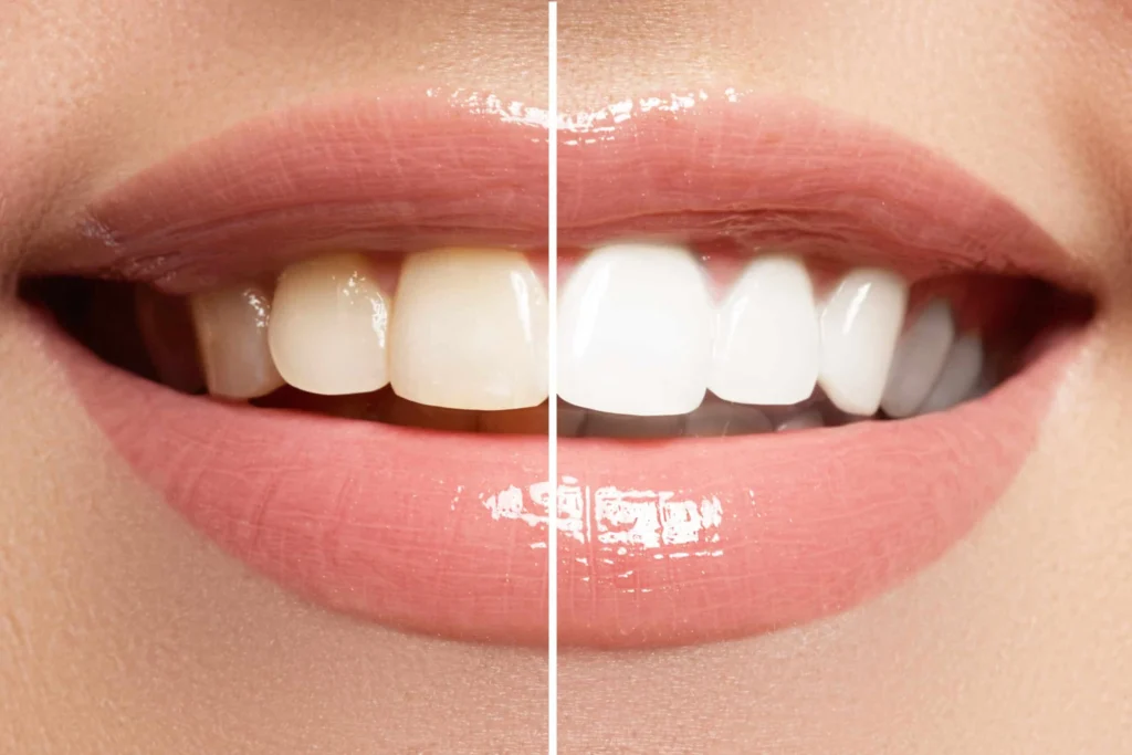 Before and after image showcasing the results of teeth whitening treatment in Dutchess County, New York. The 'before' photo shows stained teeth, while the 'after' image highlights visibly whiter and brighter teeth.